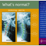 Normal Vs. Abnormal Cervical X Ray – Chiropractic Biophysics Throughout Chiropractic X Ray Report Template