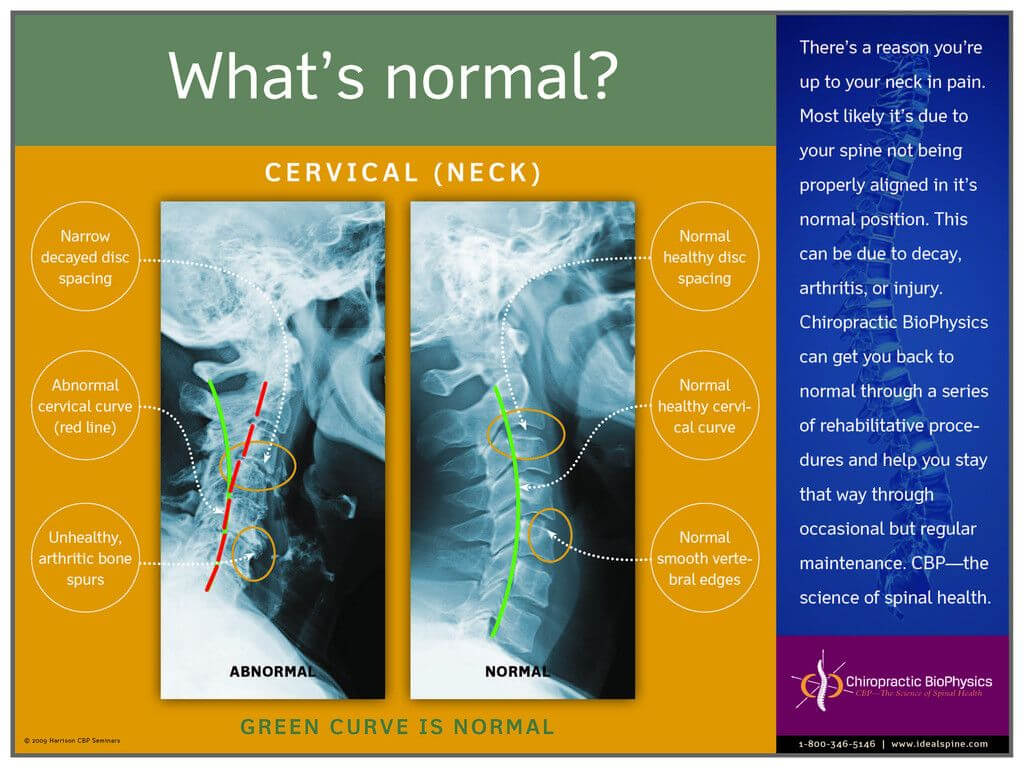Normal Vs. Abnormal Cervical X Ray – Chiropractic Biophysics Throughout Chiropractic X Ray Report Template